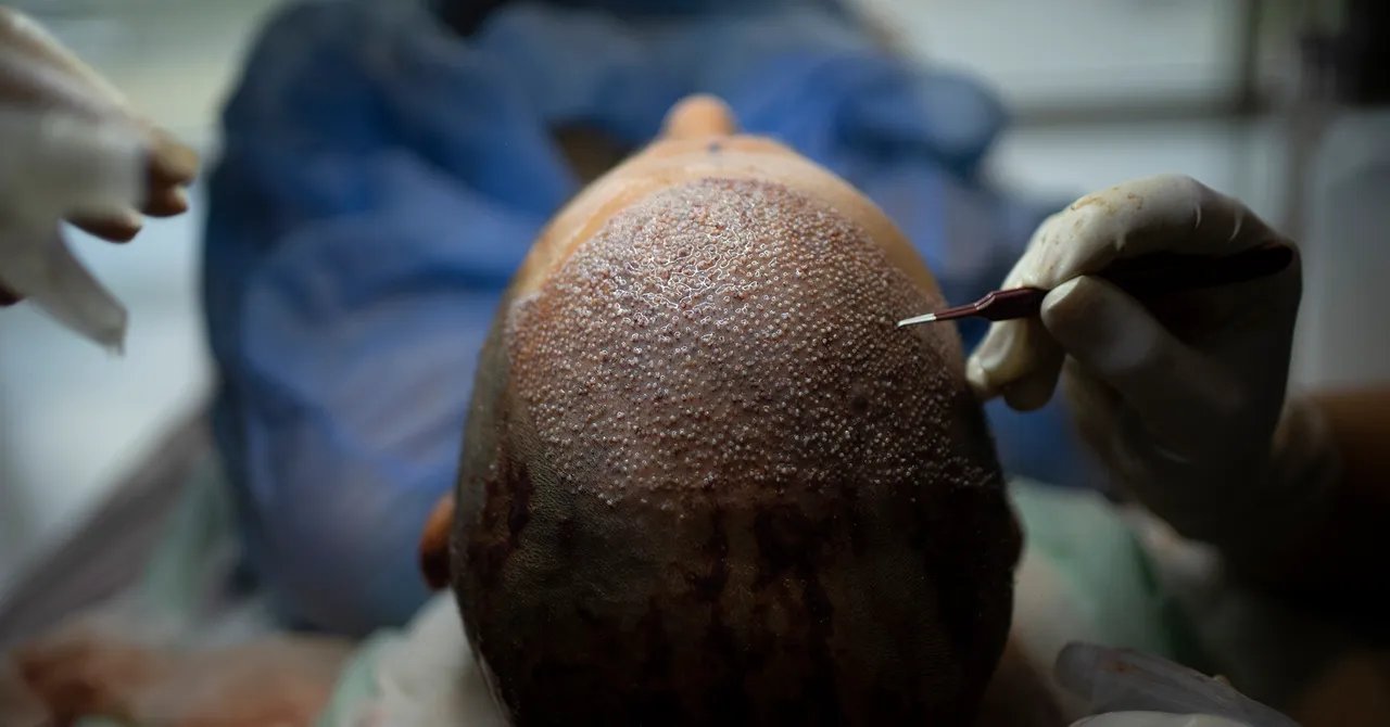 How Turkey Hacked the Hair Transplant Industry How Turkey Hacked the Hair Transplant Industry