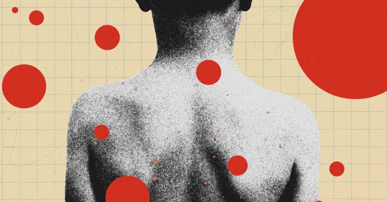 The Backward Logic of Chickenpox Parties The Backward Logic of Chickenpox Parties